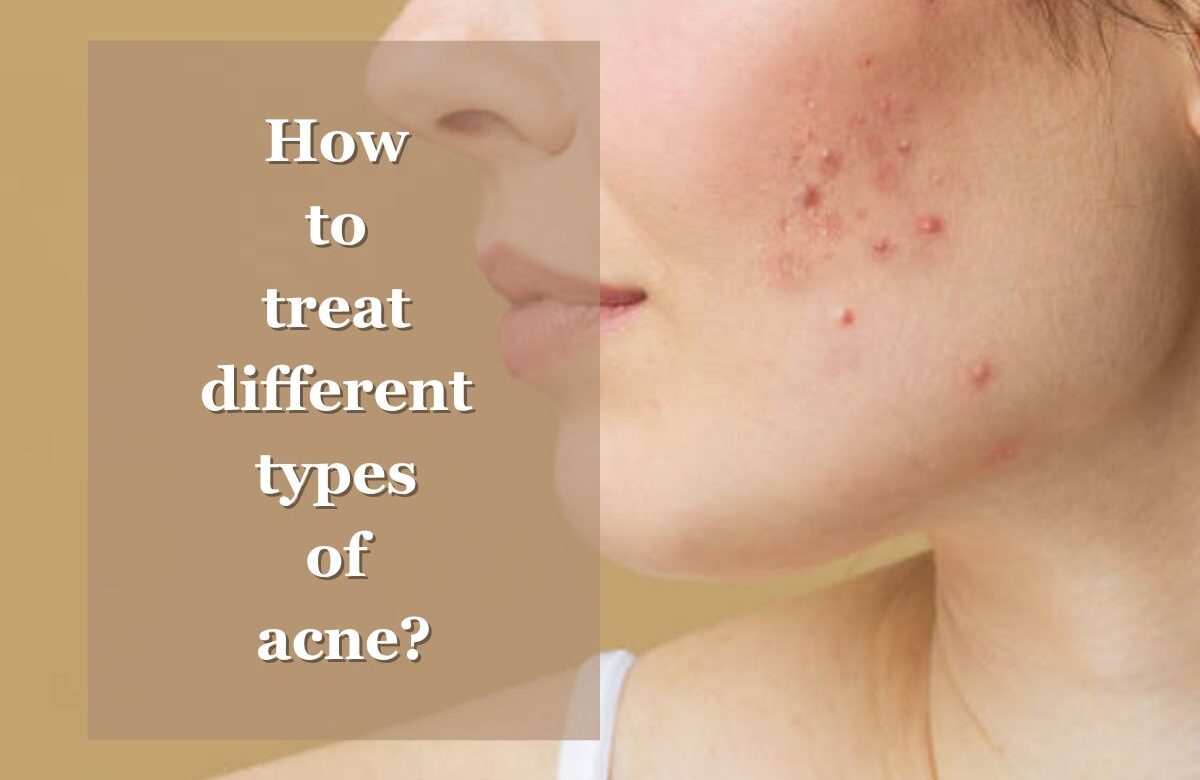 How to treat different types of acne?