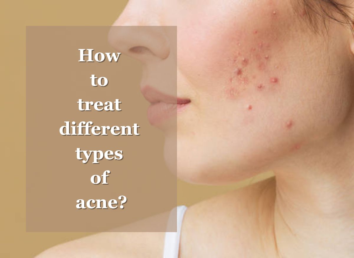  How to treat different types of acne?